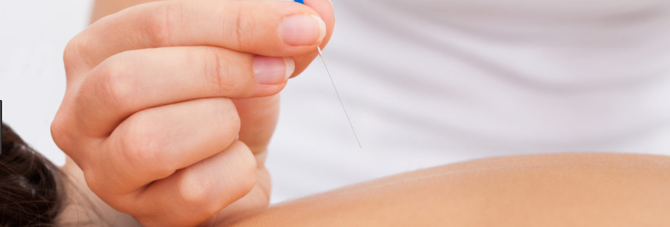 DRY NEEDLING - PROFESSIONAL DAY